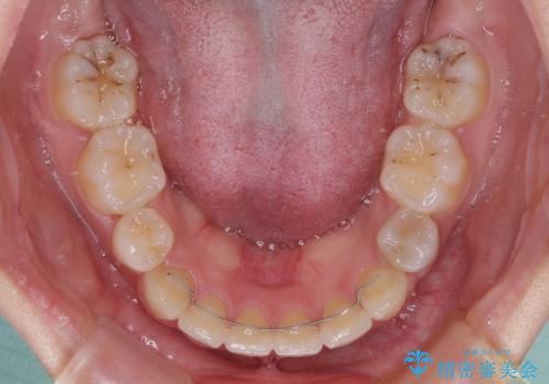 【モニター】治療途中で引っ越し ワイヤー装置を用いた抜歯矯正の治療後