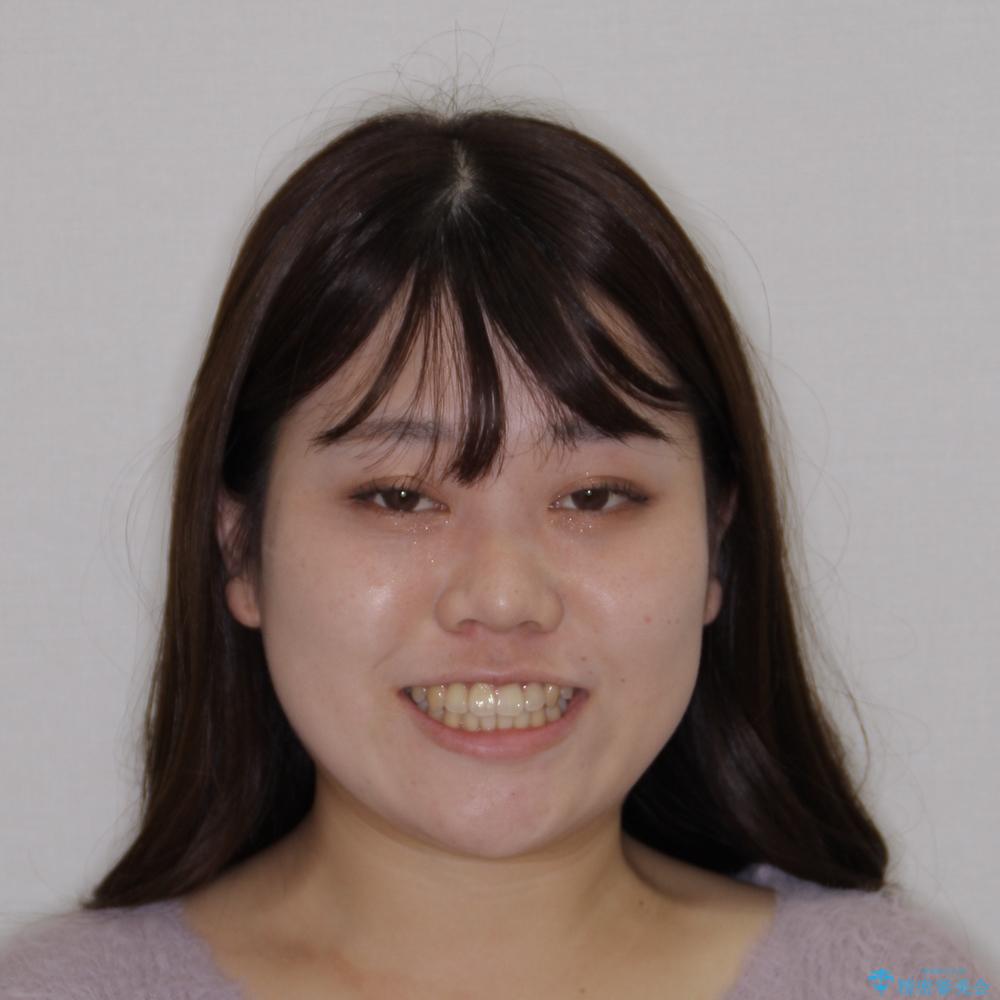 【モニター】前歯のデコボコを改善 ワイヤー矯正を併用したインビザライン矯正の治療後(顔貌)