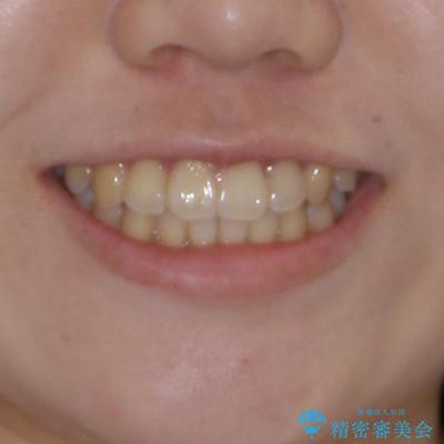 前歯のデコボコを改善　ワイヤー矯正を併用したインビザライン矯正の治療後（顔貌）