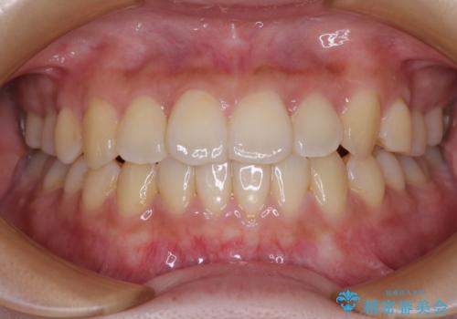 前歯のデコボコを改善　ワイヤー矯正を併用したインビザライン矯正の症例 治療後