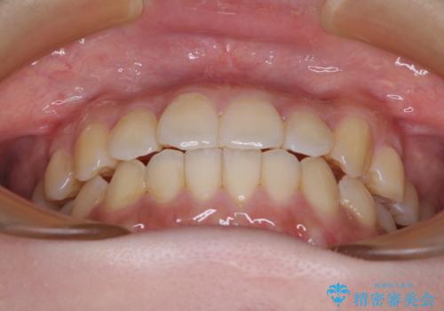 【モニター】前歯のデコボコを改善 ワイヤー矯正を併用したインビザライン矯正の治療後