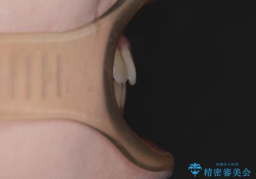 前歯のデコボコを改善　ワイヤー矯正を併用したインビザライン矯正の治療後