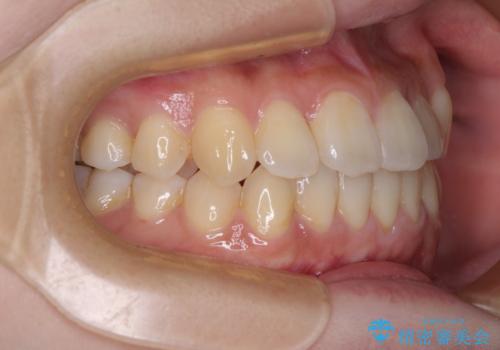 【モニター】前歯のデコボコを改善 ワイヤー矯正を併用したインビザライン矯正の治療後