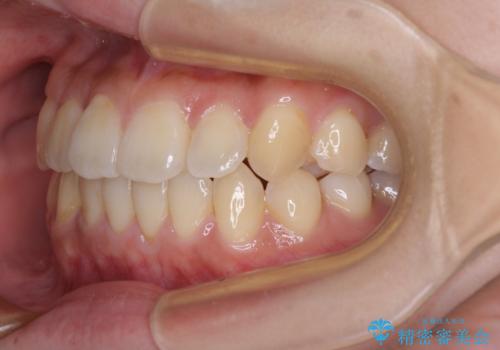 【モニター】前歯のデコボコを改善 ワイヤー矯正を併用したインビザライン矯正の治療後