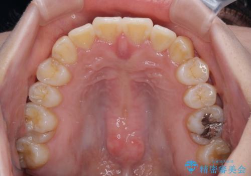 【モニター】前歯のデコボコを改善 ワイヤー矯正を併用したインビザライン矯正の治療後