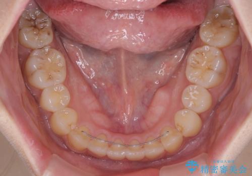 前歯のデコボコを改善　ワイヤー矯正を併用したインビザライン矯正の治療後