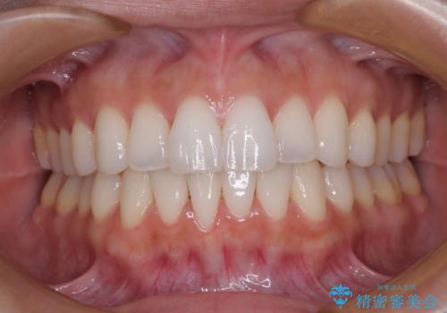 前歯のクロスバイト　インビザラインによる矯正治療の症例 治療後