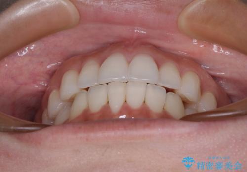 前歯のクロスバイト インビザラインによる矯正治療の治療後