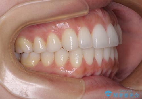 前歯のクロスバイト インビザラインによる矯正治療の治療後