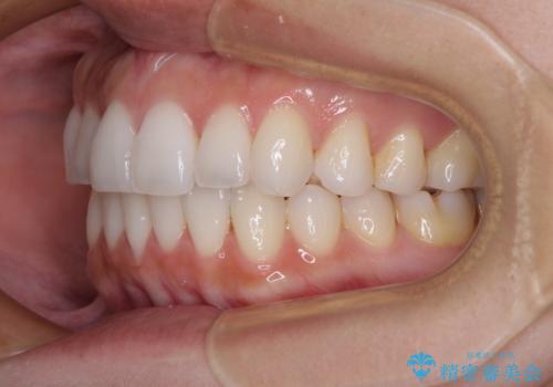 前歯のクロスバイト インビザラインによる矯正治療の治療後