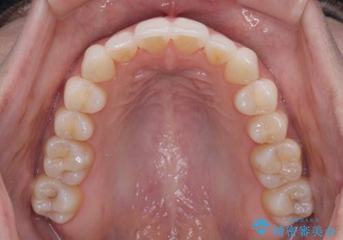 前歯のクロスバイト インビザラインによる矯正治療の治療後