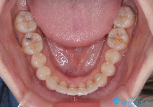 前歯のクロスバイト インビザラインによる矯正治療の治療後