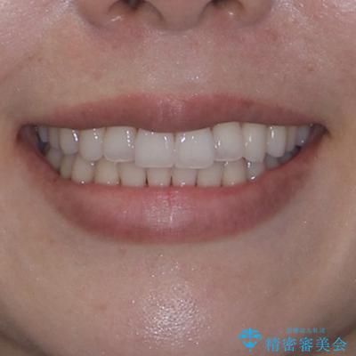前歯のクロスバイト インビザラインによる矯正治療の治療後(顔貌)