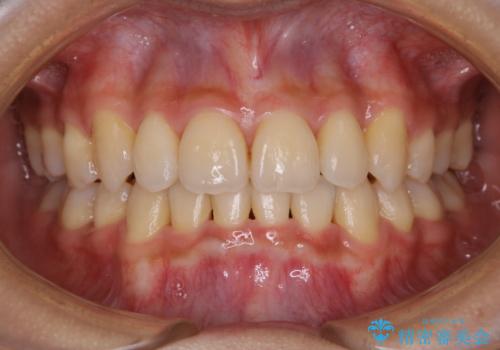 コロナ禍で矯正治療が中断:インビザラインで最終仕上げの症例 治療後