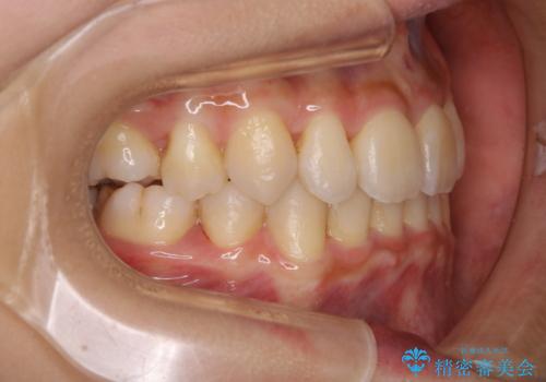 コロナ禍で矯正治療が中断:インビザラインで最終仕上げの治療後