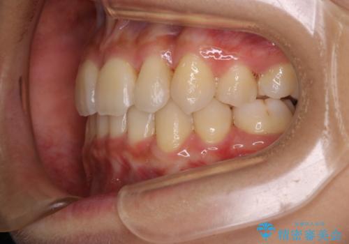 コロナ禍で矯正治療が中断:インビザラインで最終仕上げの治療後