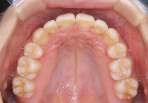 コロナ禍で矯正治療が中断:インビザラインで最終仕上げの治療後