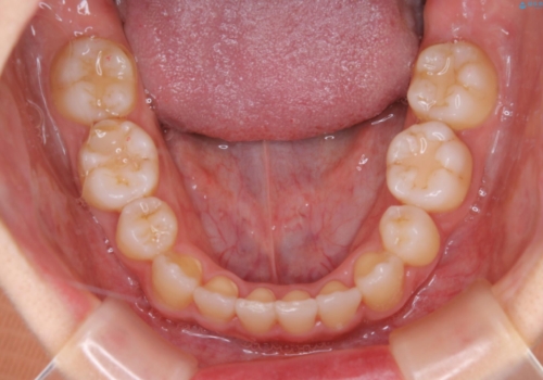 コロナ禍で矯正治療が中断:インビザラインで最終仕上げの治療後