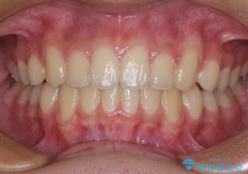 前歯の隙間とデコボコを改善　高校生のインビザライン治療の症例 治療後