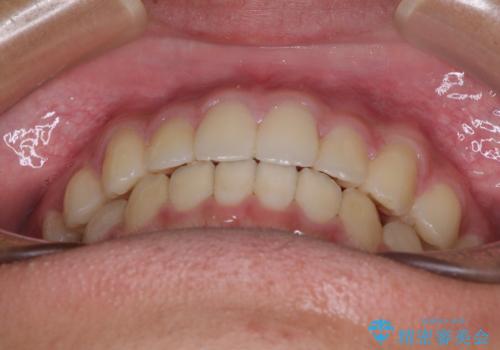 前歯の隙間とデコボコを改善 高校生のインビザライン治療の治療後