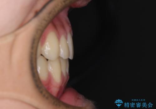 前歯の隙間とデコボコを改善 高校生のインビザライン治療の治療後