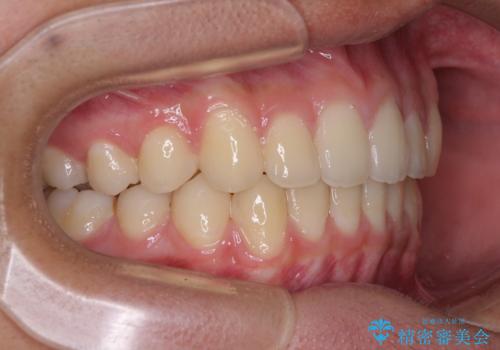 前歯の隙間とデコボコを改善　高校生のインビザライン治療の治療後