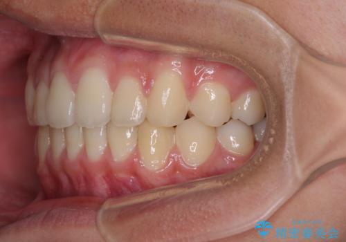 前歯の隙間とデコボコを改善　高校生のインビザライン治療の治療後