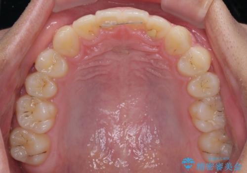 前歯の隙間とデコボコを改善 高校生のインビザライン治療の治療後