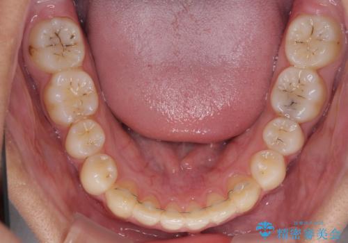 前歯の隙間とデコボコを改善 高校生のインビザライン治療の治療後