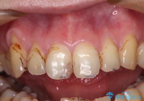 薄くて退縮しやすい前歯の歯肉　補綴治療前に歯肉移植で退縮しにくくの治療前