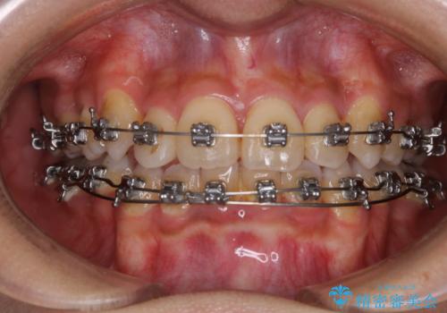 コロナ禍で矯正治療が中断:インビザラインで最終仕上げ