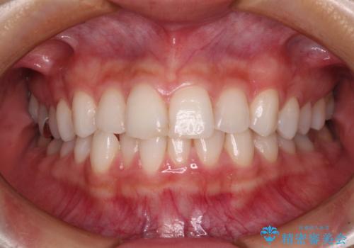 歯をきれいにしたい ワイヤー矯正治療と虫歯治療の治療前