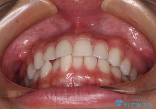 歯をきれいにしたい　ワイヤー矯正治療と虫歯治療の治療前