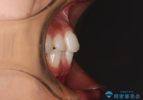 歯をきれいにしたい ワイヤー矯正治療と虫歯治療の治療前