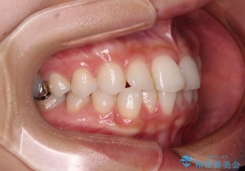 歯をきれいにしたい　ワイヤー矯正治療と虫歯治療の治療前