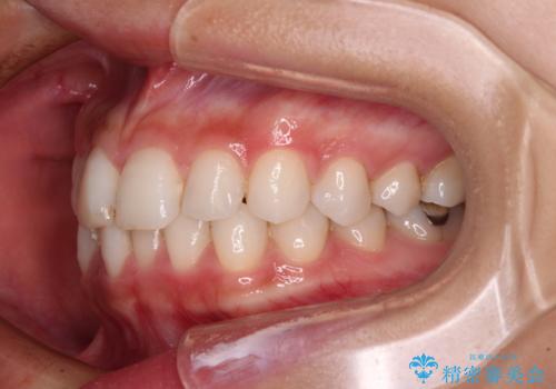 歯をきれいにしたい ワイヤー矯正治療と虫歯治療の治療前