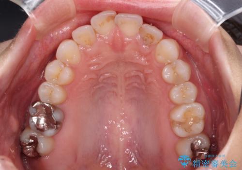 歯をきれいにしたい ワイヤー矯正治療と虫歯治療の治療前