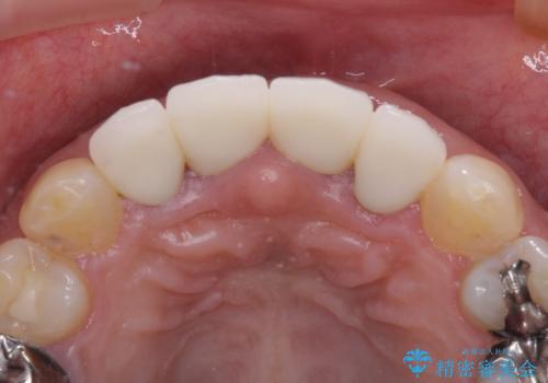 汚れた仮歯が気になる　前歯のオールセラミッククラウンの治療後