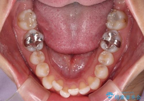 歯をきれいにしたい ワイヤー矯正治療と虫歯治療の治療前