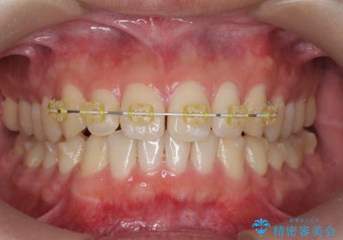 前歯のすれ違い　マウスピース矯正の治療中