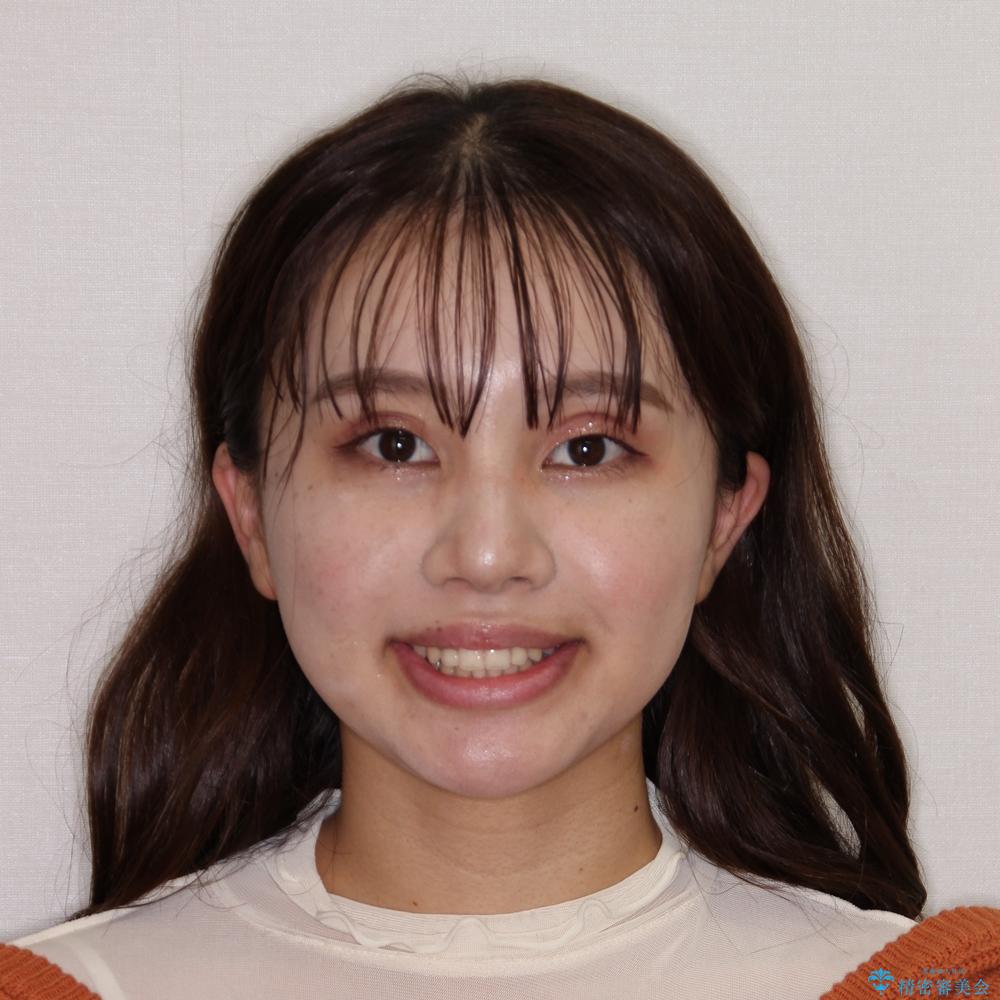 【モニター】前歯のデコボコと変色した前歯をインビザラインとオールセラミッククラウンでの治療後(顔貌)