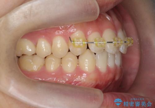 前歯のすれ違い マウスピース矯正の治療中
