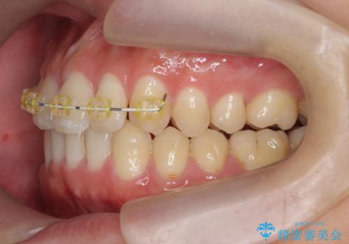 前歯のすれ違い　マウスピース矯正の治療中