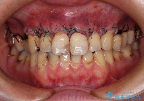 薄くて退縮しやすい前歯の歯肉　補綴治療前に歯肉移植で退縮しにくくの治療中