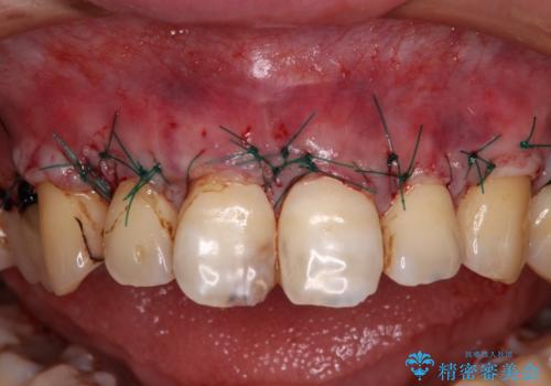 薄くて退縮しやすい前歯の歯肉　補綴治療前に歯肉移植で退縮しにくくの治療中