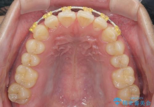 前歯のすれ違い マウスピース矯正の治療中