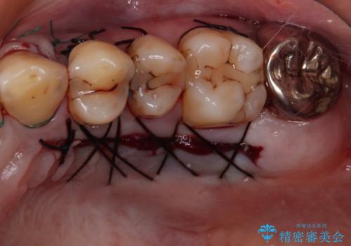 薄くて退縮しやすい前歯の歯肉　補綴治療前に歯肉移植で退縮しにくくの治療後