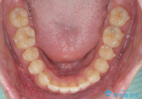 前歯のすれ違い マウスピース矯正の治療中