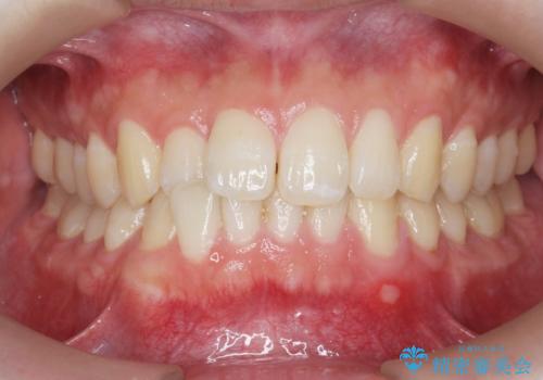 前歯のすれ違い　マウスピース矯正の症例 治療前