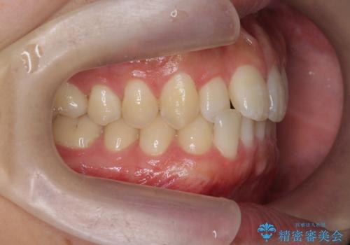 前歯のすれ違い　マウスピース矯正の治療前